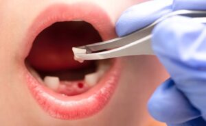 Erek Erek Gigi Copot 2D 3D 4D Menurut Buku Mimpi Terbaru 2026