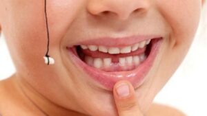 Erek Erek Gigi Copot Bagian Atas 2D 3D 4D Menurut Buku Mimpi Terbaru 2026