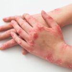 Erek Erek Sakit Kudis 2D 3D 4D Menurut Buku Mimpi Terbaru 2026