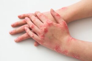 Erek Erek Sakit Kudis 2D 3D 4D Menurut Buku Mimpi Terbaru 2026